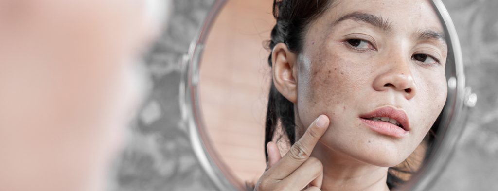 best melasma creams in 2022